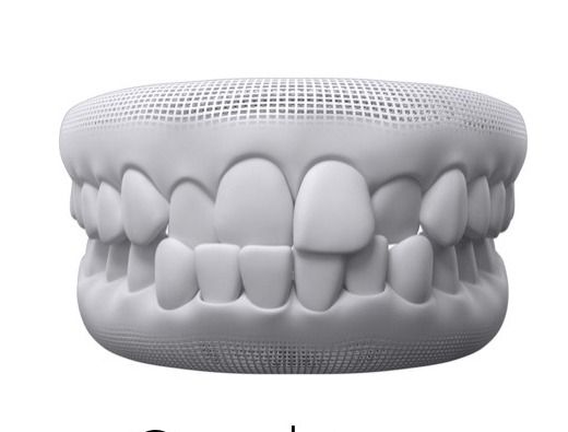 3D model showing a crossbite