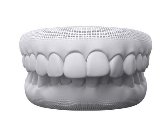 3D model showing deep bite and increased overjet
