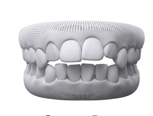 3D model showing an open bite